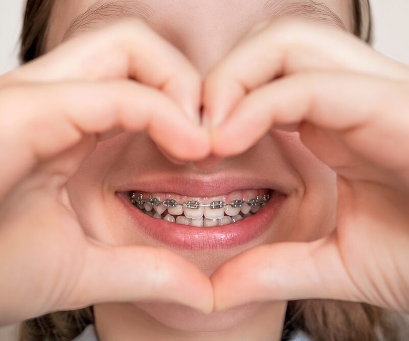 What are Fast Braces? 5 Reasons You Should Consider Them