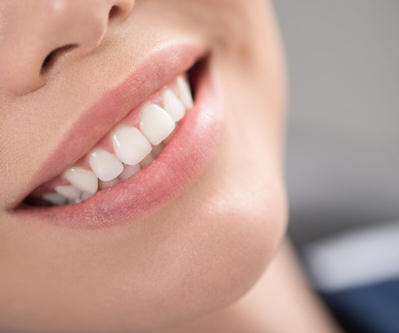 Do Veneers stain like natural teeth?