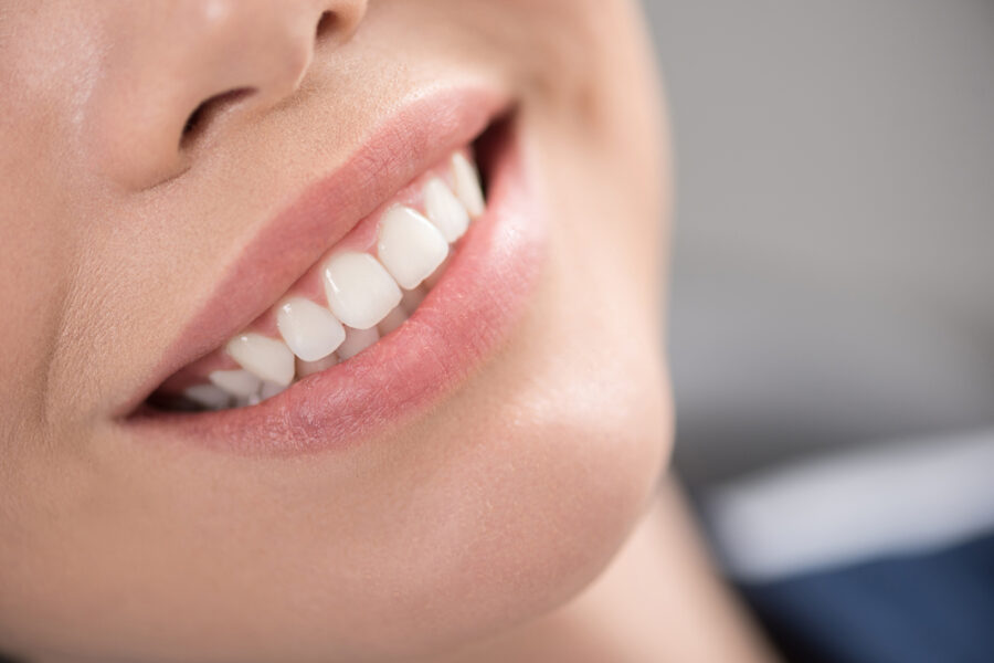 Do Veneers stain like natural teeth?