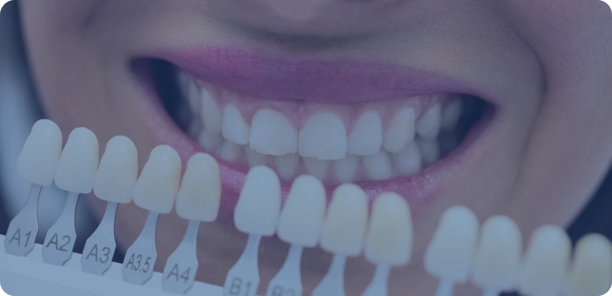 Dental Crowns Orlando