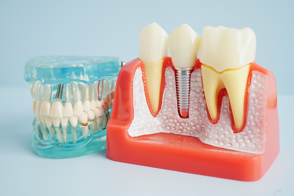 Dental Implants in Orlando